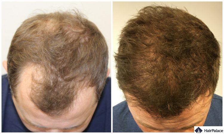Neils Stunning Hair Transplant Result After 12 Months HairPalace