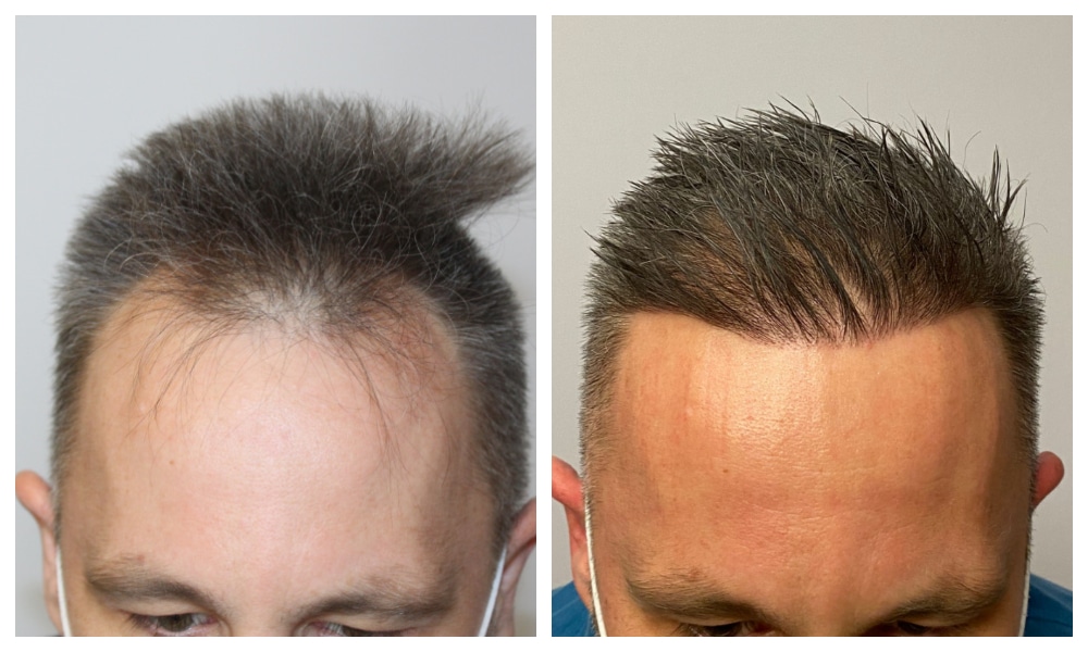Hair Transplant Before And After Top Pictures In