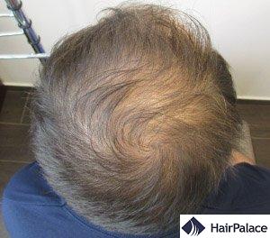 HairPalace Hair Transplantation Clinic in Hungary (EU) - Save 50%