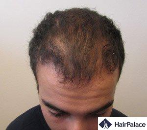 HairPalace Hair Transplantation Clinic in Hungary (EU) - Save 50%