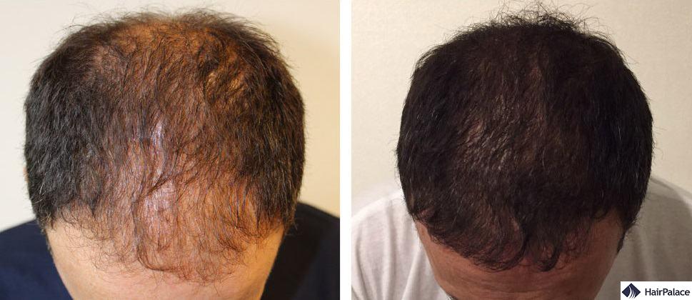 Hair Transplant Before And After Photos - Hairpalace