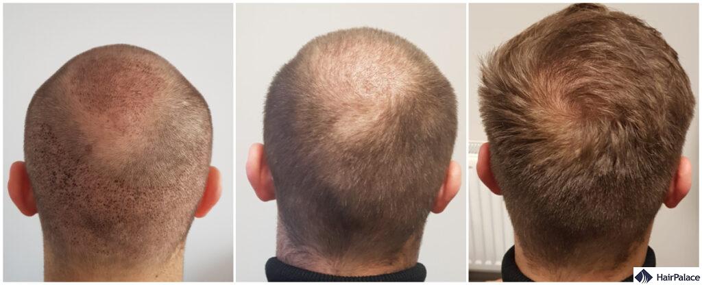 donor area recovery after hair transplant