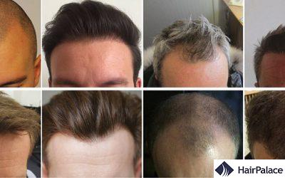 HairPalace Hairclinic - Hair Transplant in Budapest, Hungary (EU member)