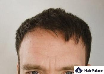 Hairline Surgery Hairpalace