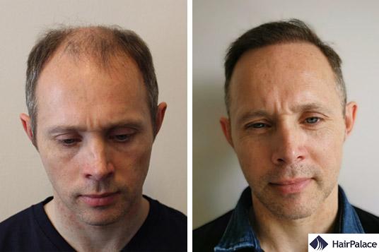 Hair transplant in Switzerland: Prices and Services | HairPalace