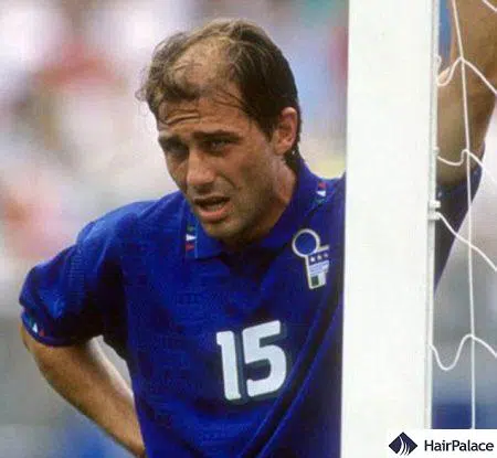 antonio-conte-hair-transplant-before-e1612351631915.jpg.webp