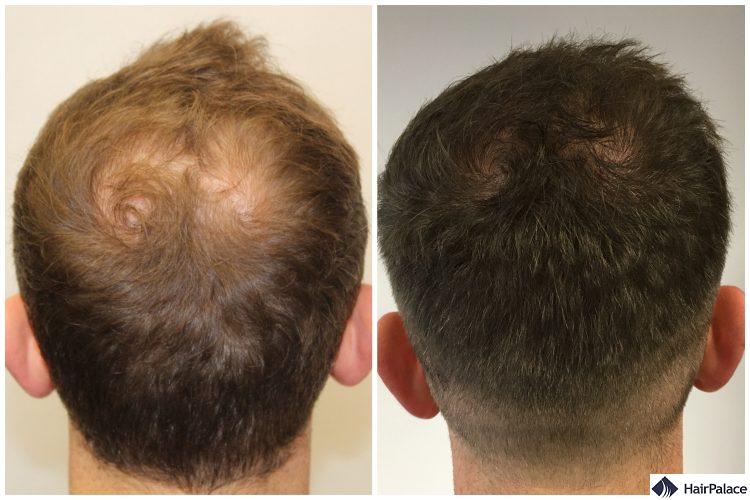 Figure 9 from Outcome of Intraoperative Injected Plateletrich Plasma  Therapy During Follicular Unit Extraction Hair Transplant A Prospective  Randomised Study in Forty Patients  Semantic Scholar
