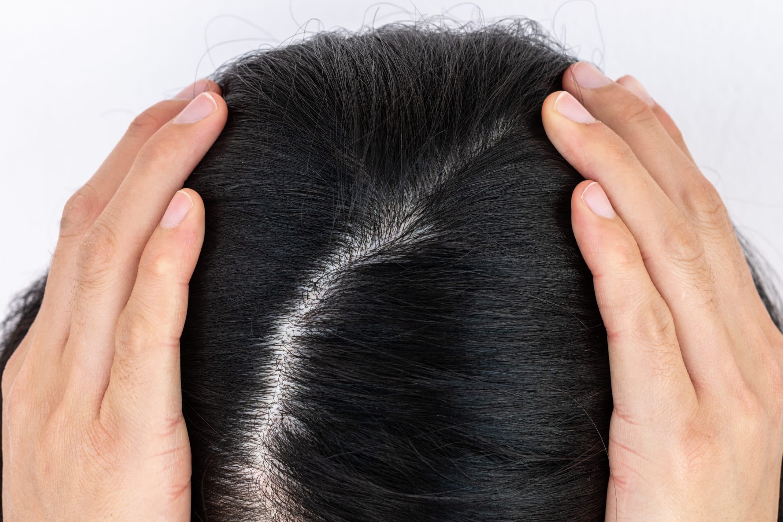 Myths of Human Genetics Hair Whorl