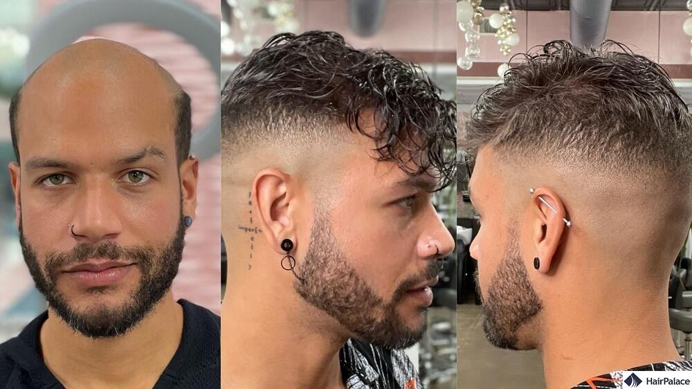 hair replacement system for men