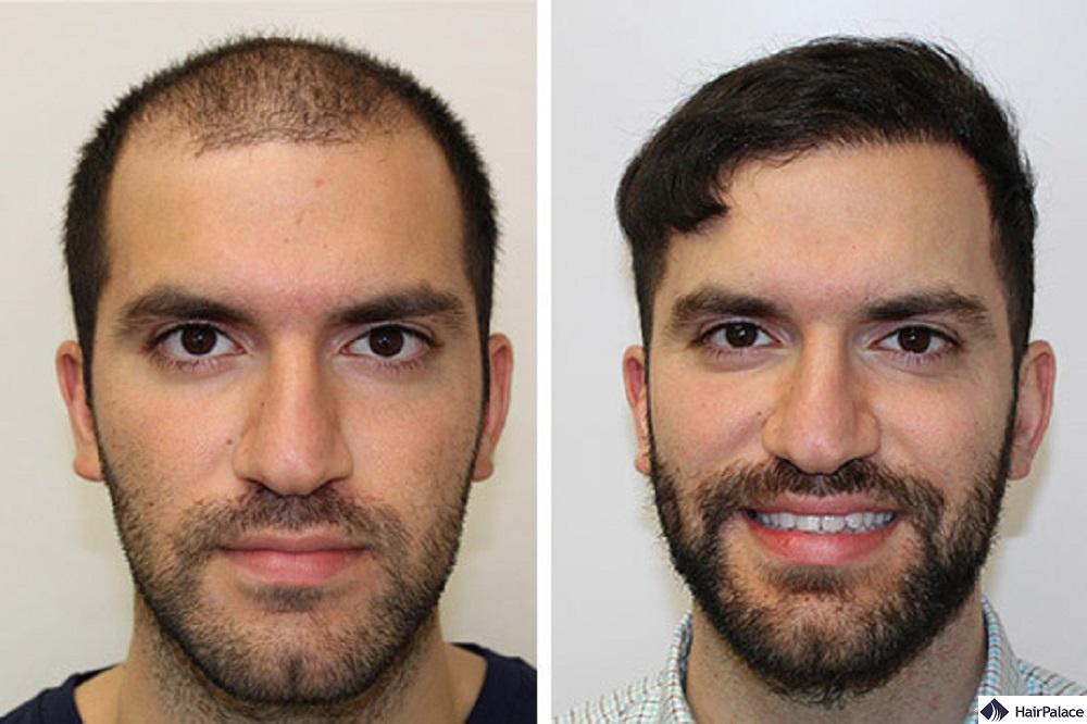 Before and After Hair Transplant  iGraft Global Pioneer in DFI Gen3 Hair  and Skin Treatments