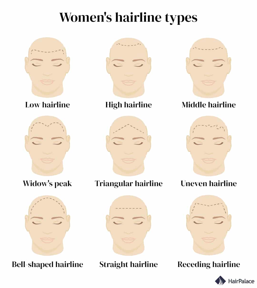 Womens Hairline Types 