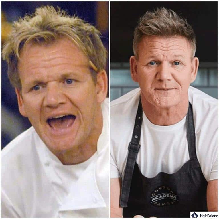 Gordon Ramsay Hair Transplant How Much Did It Cost 