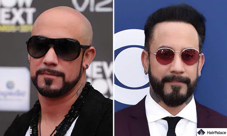 AJ mclean hair transplant before and after