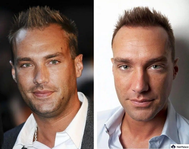 Calum Best hair transplant before and after