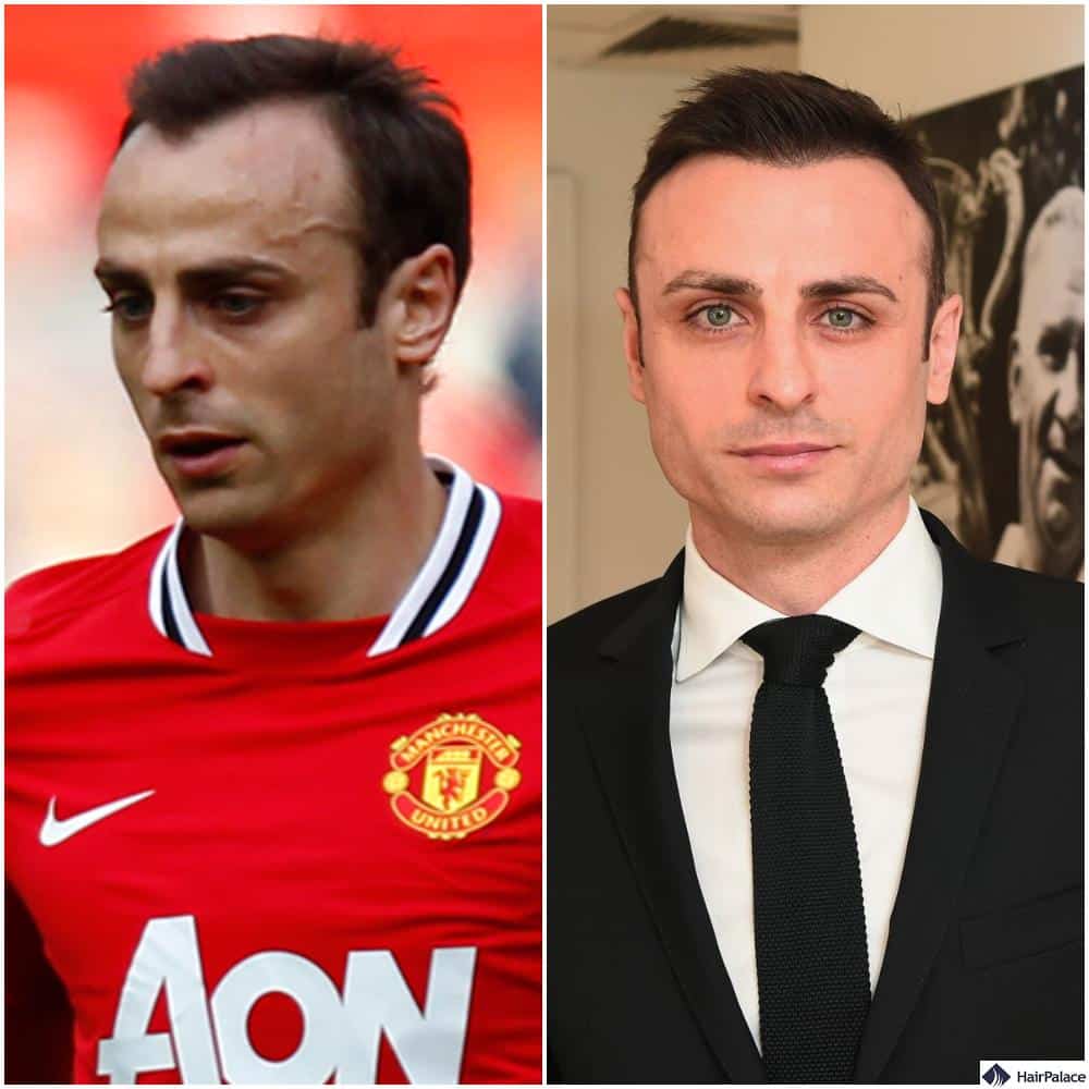 Dimitar Berbatoc hair transplant before and after