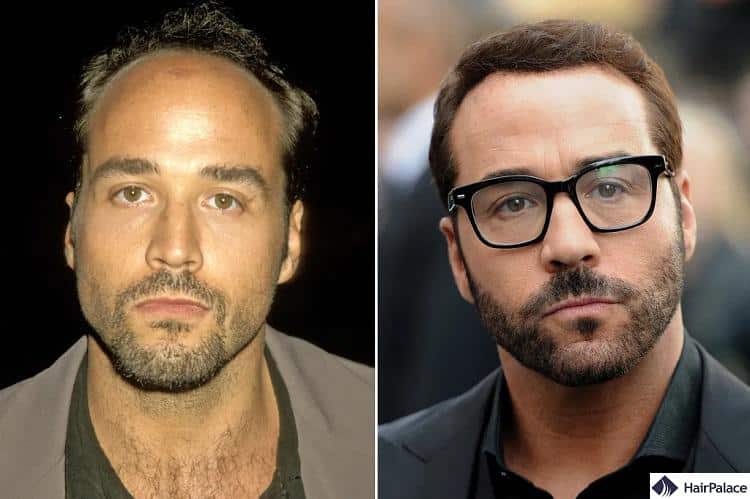 Jereamy Piven hair transplant before and after