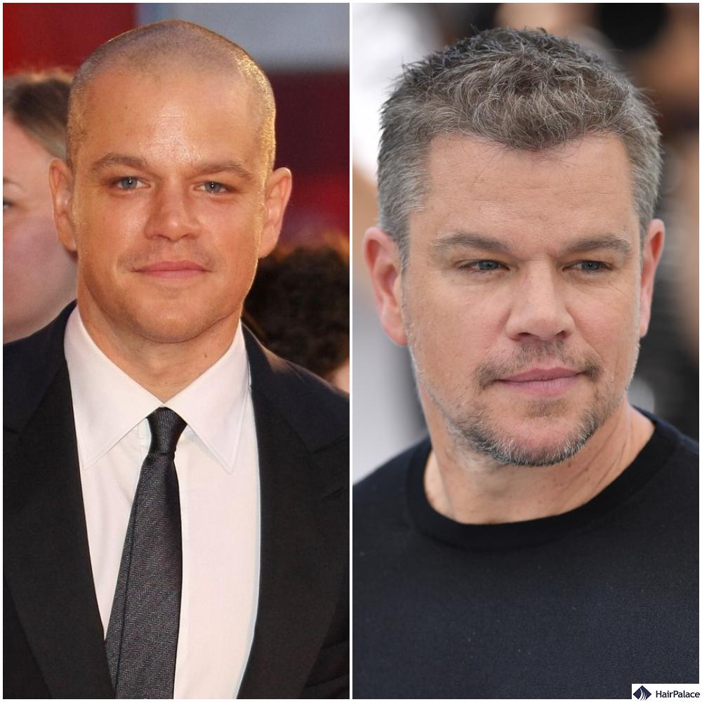 Matt Damon hair transplant before and after