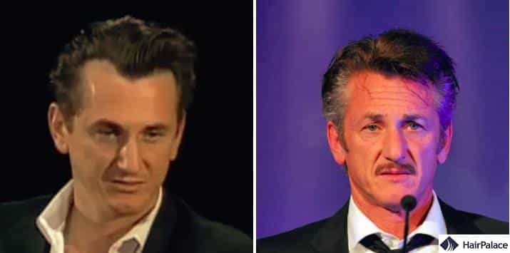 Sean Penn hair transplant before and after