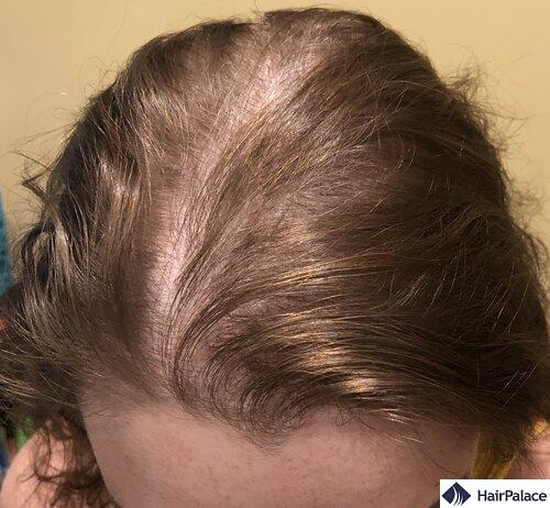 Hair Thinning On The Top 