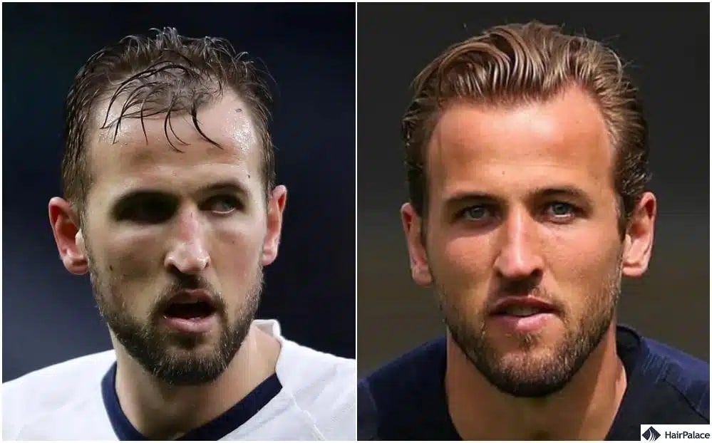 Did Harry Kane have a hair transplant? the answer is most likely yes