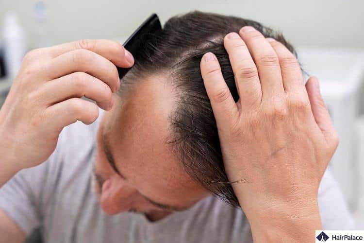 Hair loss treatment What you need to know about Finasteride