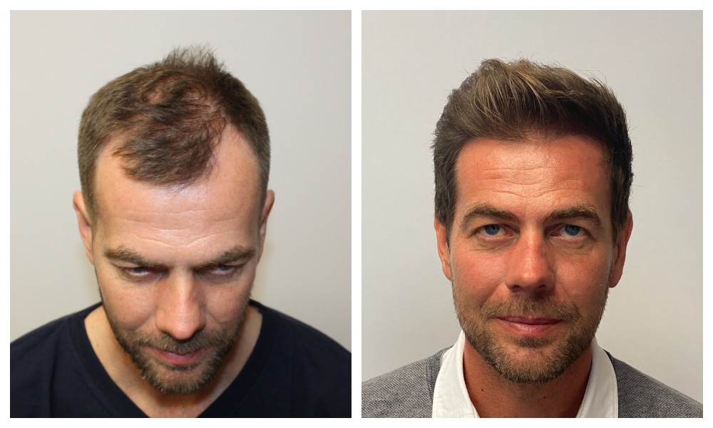 Hair Transplant Before And After Top 10 Pictures In 2023
