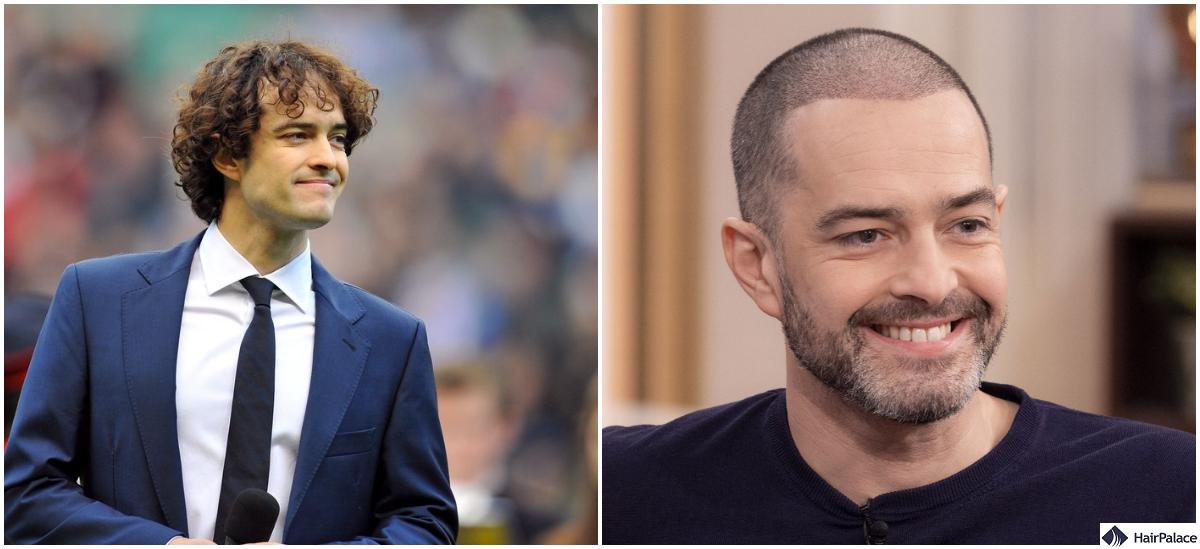 Lee Mead Hair Transplant Breakdown