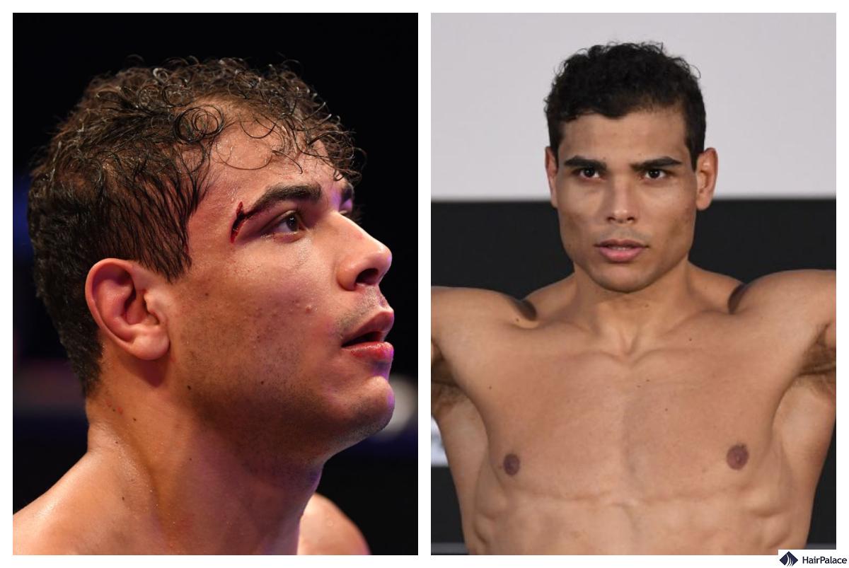 Paulo Costa Hair Transplant: Fighting for the Perfect Hairline