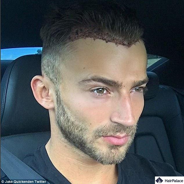 jake quickenden after hair transplant operation