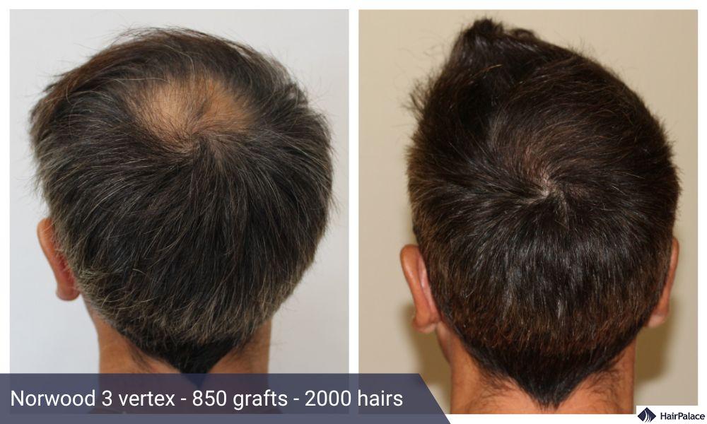 crown hair transplant before after