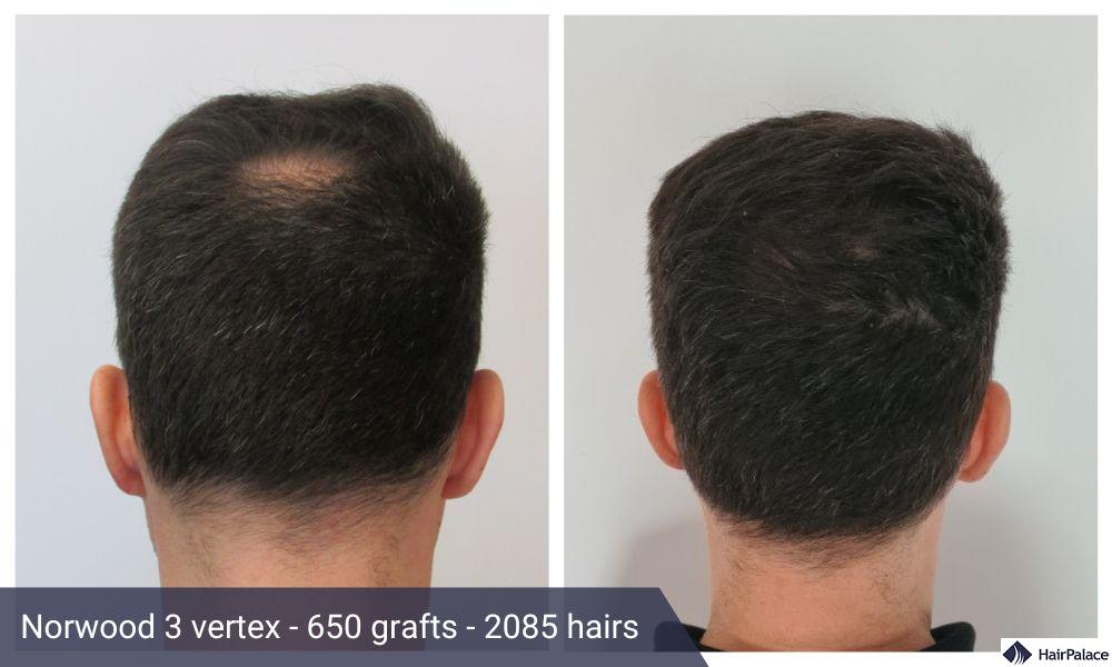 crown hair transplant norwood 3 vertex