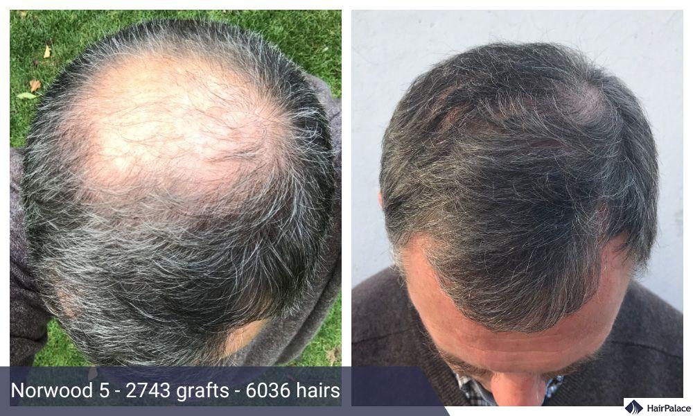 hair transplant on norwood 5 crown hair loss