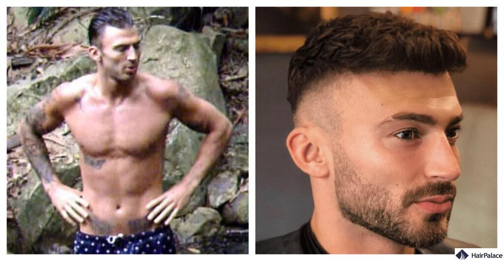 jake quickenden before and after hair transplant