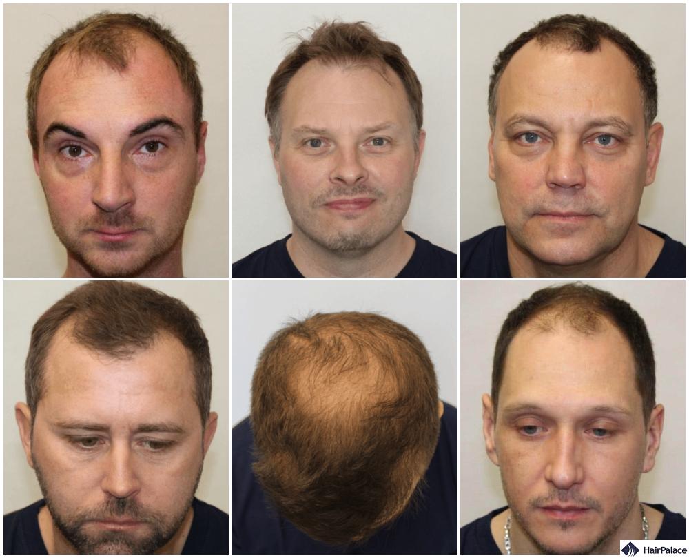 male pattern baldness photos