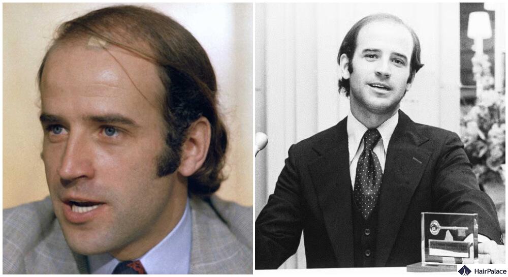 joe biden hair loss progression