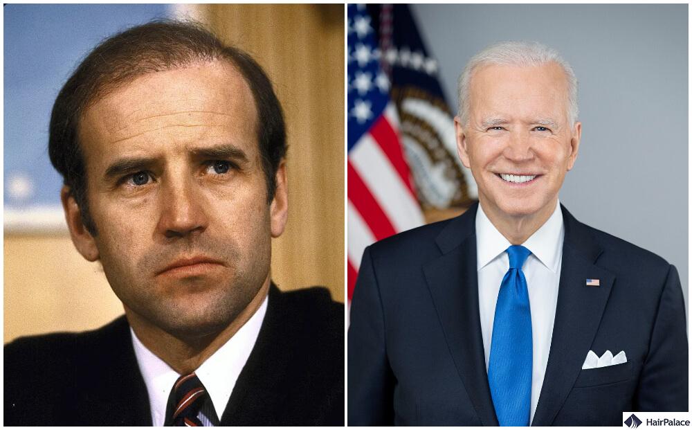 joe biden hair transplant final result