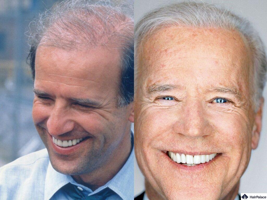 joe biden before and after hair transplant