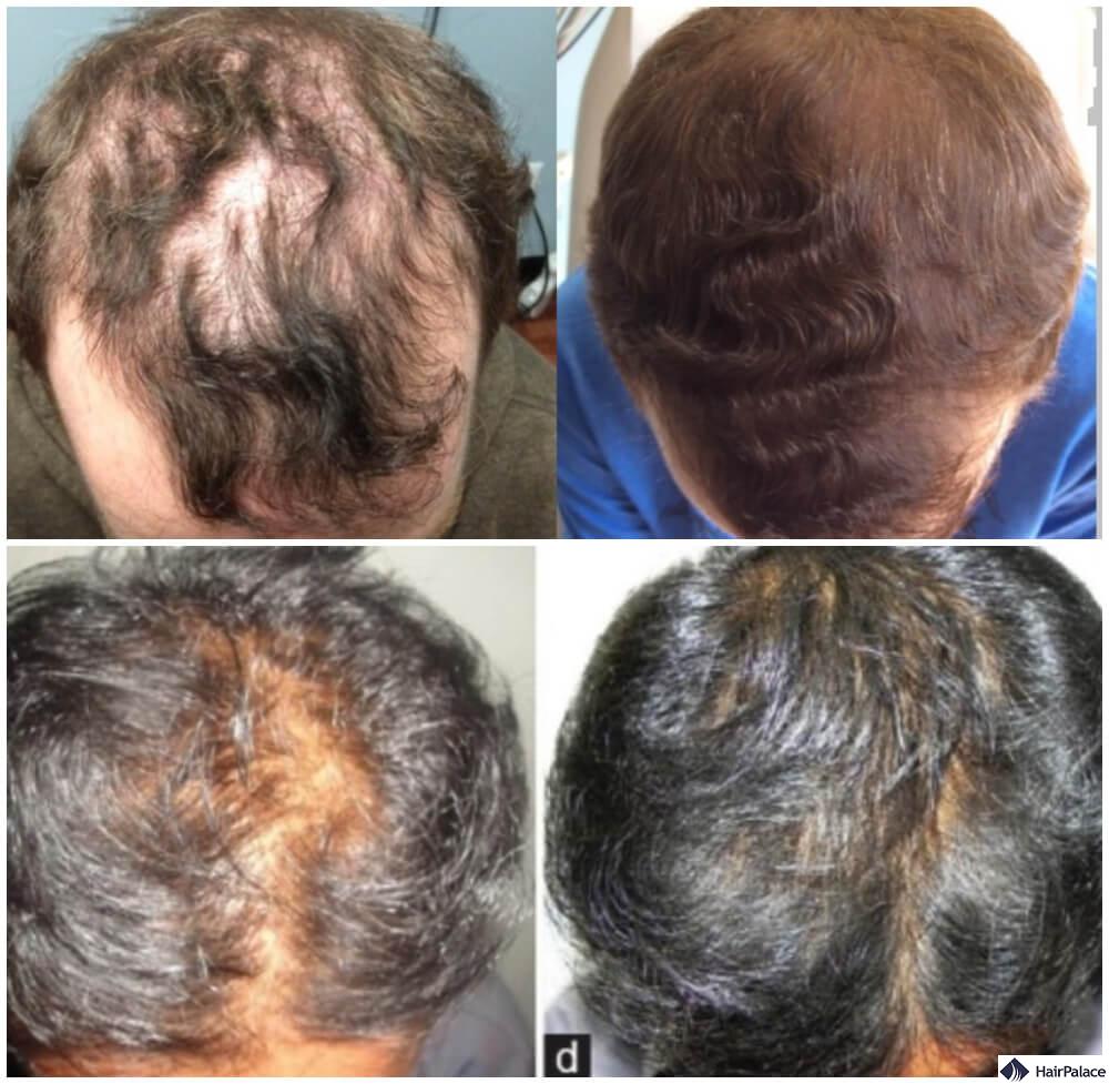 topical finasteride before and after results