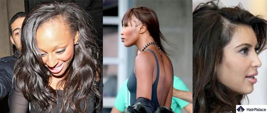 celebrities wth traction alopecia