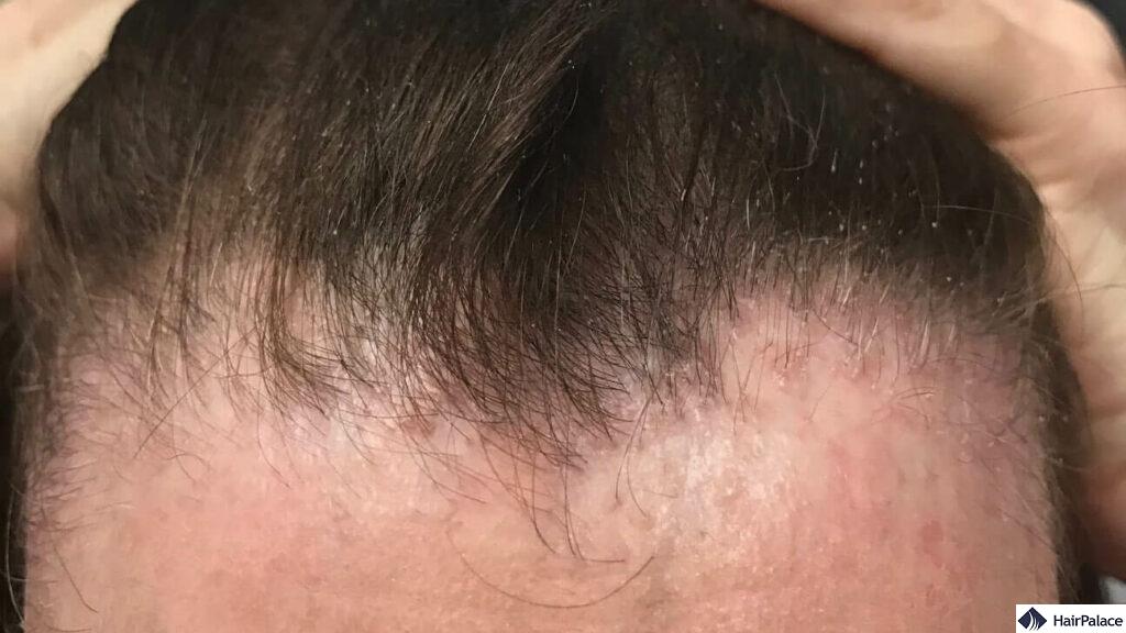 hair loss at the hairline is an early sign of traction alopecia