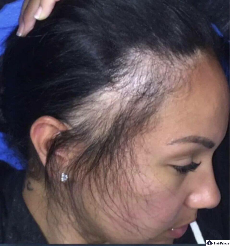 symptomes of late stage traction alopecia