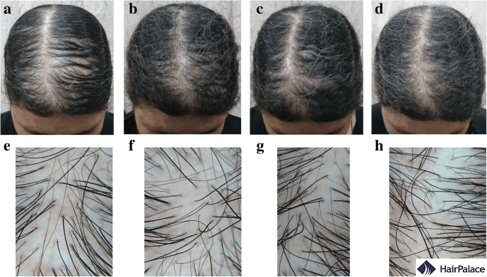 nizoral shampoo hair loss before after