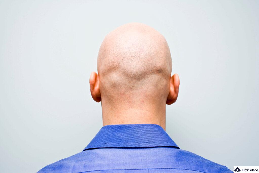 temporary baldness from accutane hair loss