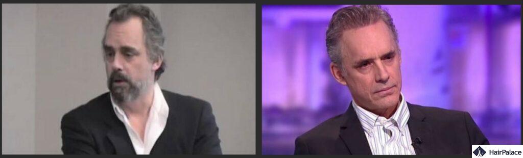 jordan peterson before and after hair transplant