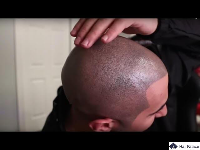 an unnatural aapperance is one of the main source of scalp micropigmentation regrets