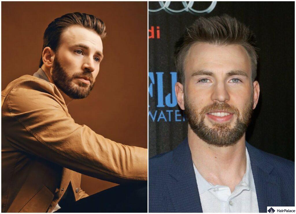 The chris evans hair transplant probably never took place