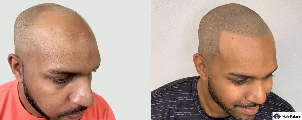 scalp micropigmentation results