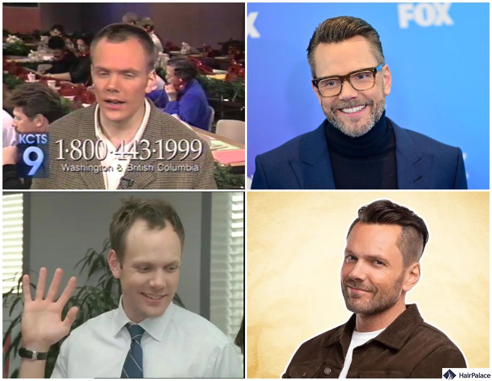 joel mchale before and after hair transplant