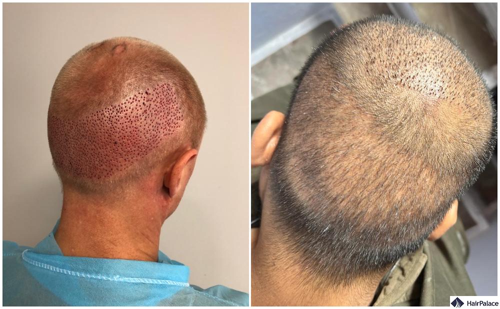 overharvesting hair transplant results