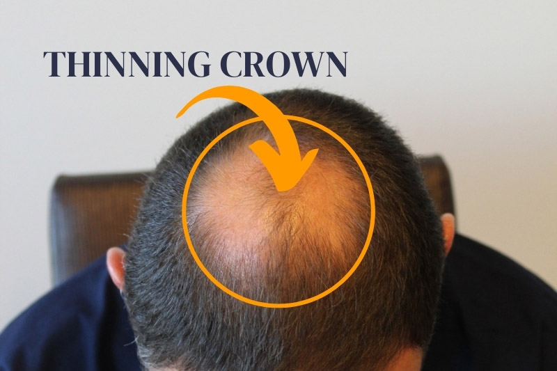 Crown Hair Transplants